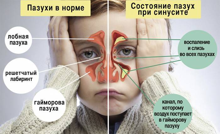 Краплі в ніс при синуситі