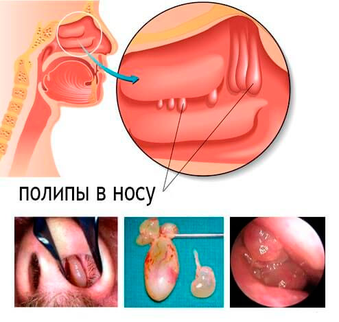 Краплі в ніс з цикламеном: аптечні і народні засоби. Краплі з цикламеном від гаймориту назва краплі з цикламеном