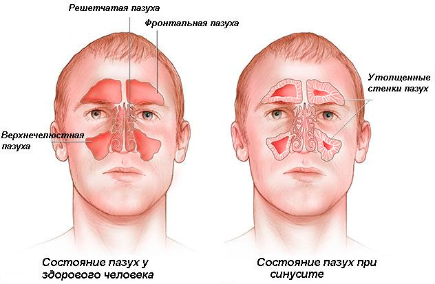 Краплі в ніс з цикламеном: аптечні і народні засоби. Краплі з цикламеном від гаймориту назва краплі з цикламеном