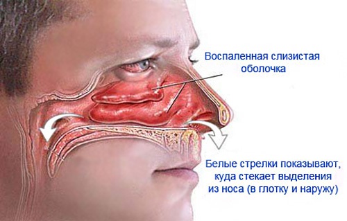 Кращі краплі в ніс що пропонує сучасна фармакологія