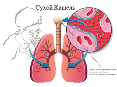 Кращі ліки від сухого кашлю дорослим
