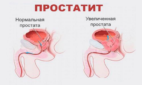 Кращі народні методи швидкого лікування простатиту