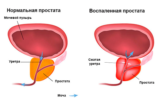 Кращі народні засоби від простатиту у чоловіків