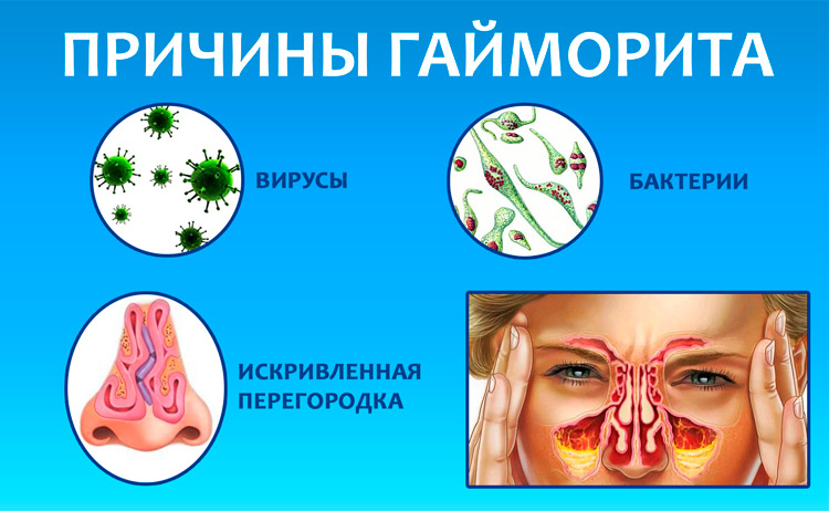 Кращі спреї від гаймориту у дорослих