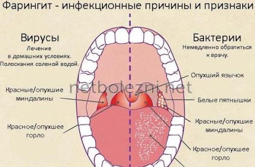 Кращі таблетки пастилки спреї і аерозолі від фарингіту