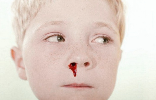 Кровотеча з носа у дітей: причини і лікування, перша допомога