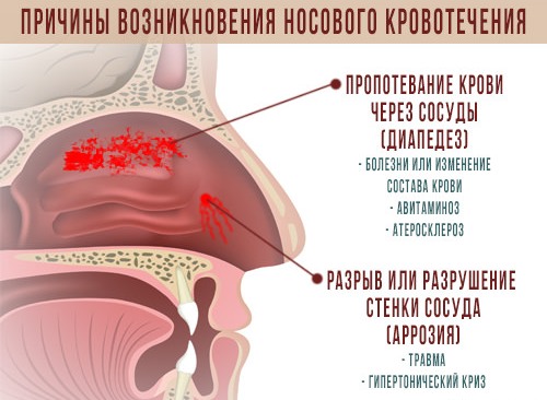 Кровотеча з носа у дітей: причини і лікування, перша допомога