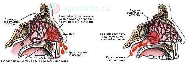 Кровотеча з носа як зміцнити судини