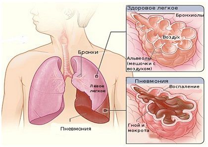 Крупозна пневмонія: симптоми і лікування