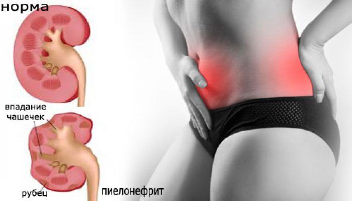 Лікарський збір при пієлонефриті — Нирки і МКБ Лікарський збір при пієлонефриті — Нирки і МКБ