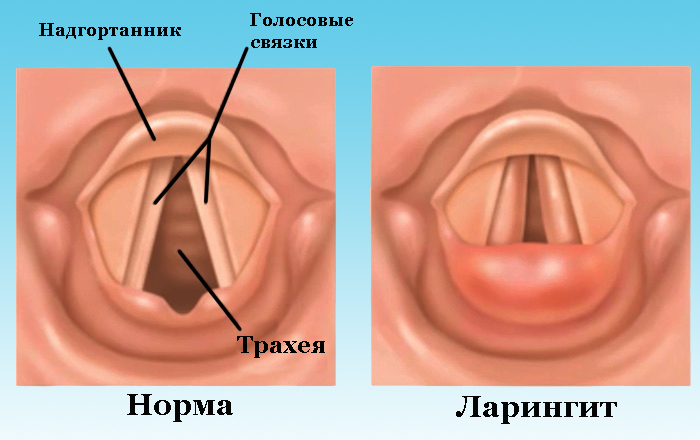 Ліки від ларингіту для дітей спреї таблетки сиропи і антибіотики