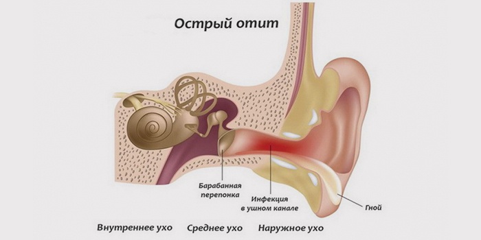 Лікуємо отит в домашніх умовах: як лікувати запалене вухо?