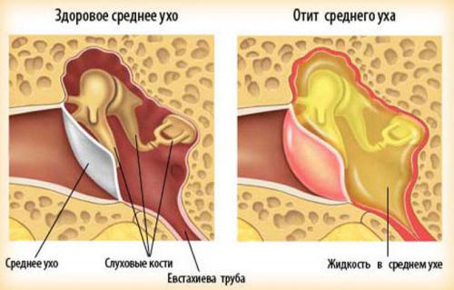 Лікуємо отит в домашніх умовах: як лікувати запалене вухо?