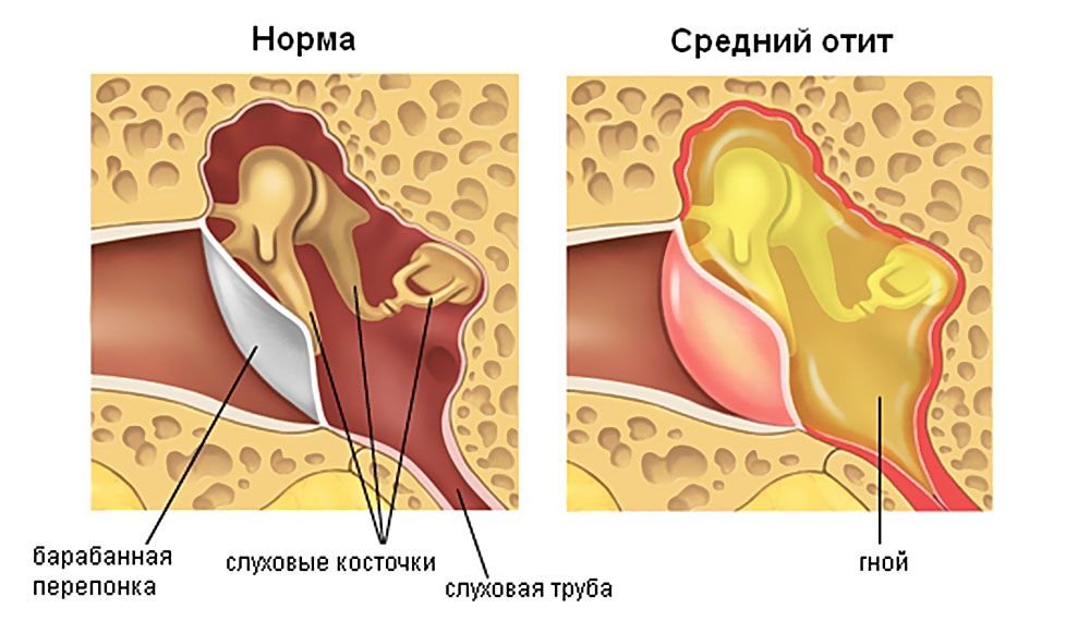 Лікуємо отит в домашніх умовах: як лікувати запалене вухо?