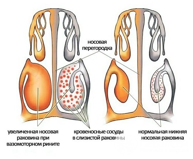 Лікуємо вазомоторний риніт народними засобами