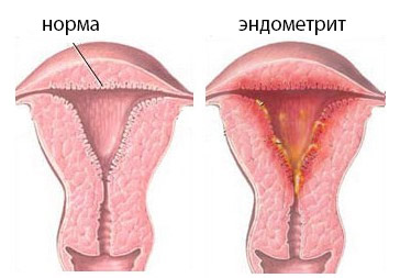 Лікувально-діагностичне вишкрібання порожнини матки цілі і способи проведення