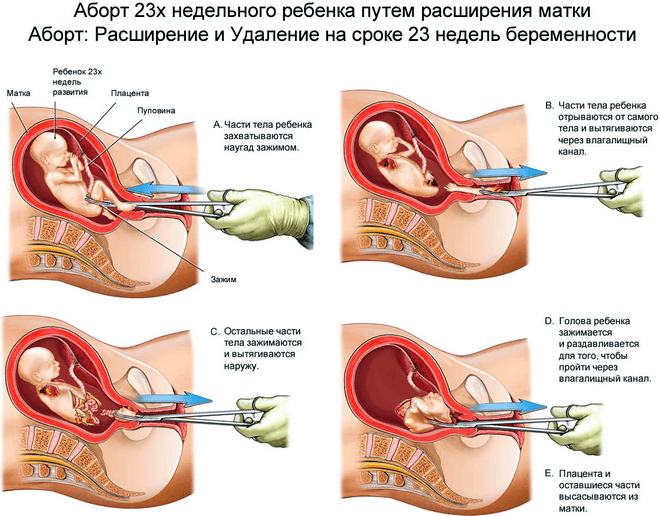 Лікувально-діагностичне вишкрібання порожнини матки цілі і способи проведення