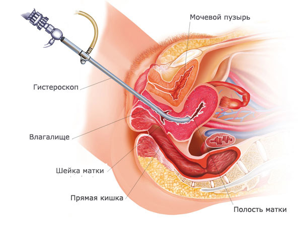 Лікувально-діагностичне вишкрібання порожнини матки цілі і способи проведення