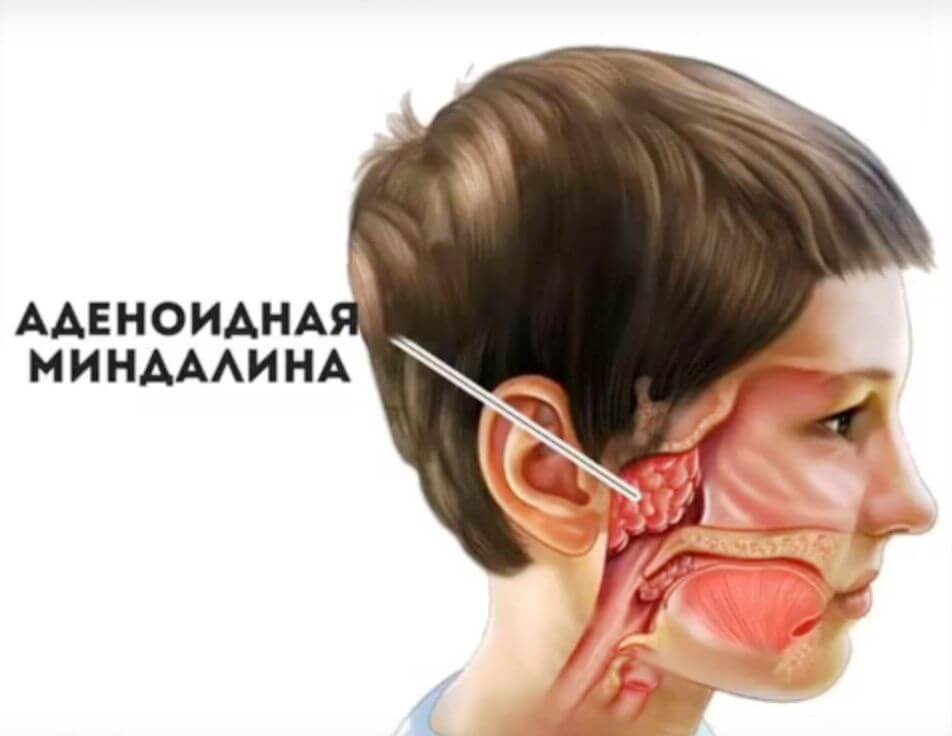 Лікування аденоїдів другого ступеня