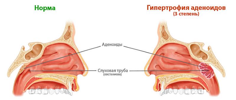 Лікування аденоїдів у дітей лазером (лазеротерапія)
