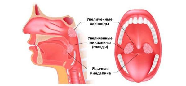Лікування аденоїдів у домашніх умовах