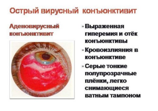 Лікування аденовірусної інфекції у дорослих