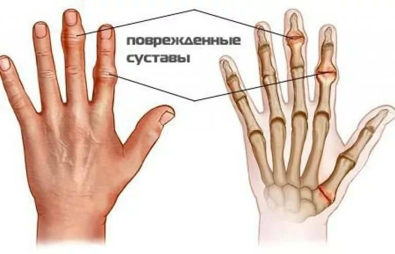 Лікування артриту артрозу народними засобами в домашніх умовах –
