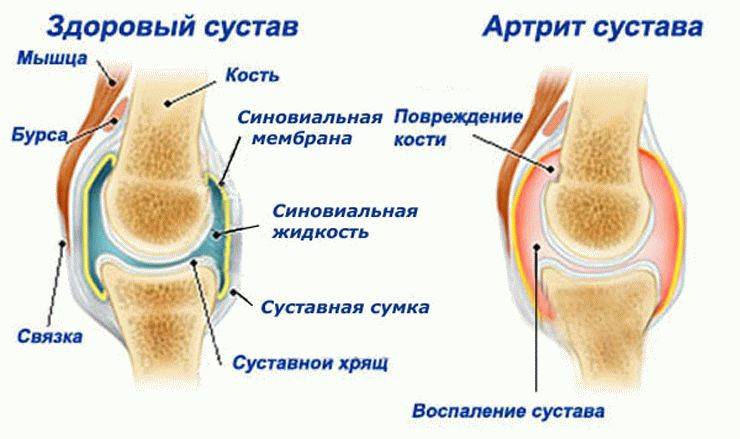 Лікування артриту в домашніх умовах народними засобами