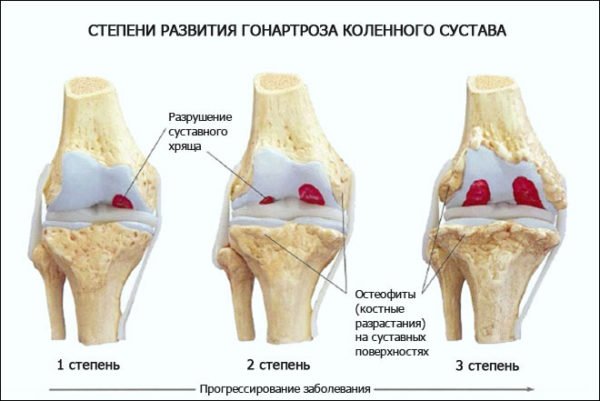 Лікування артрозу колінного суглоба в домашніх умовах народними засобами