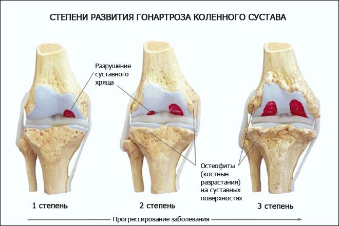 Лікування артрозу колінного суглоба в домашніх умовах народними засобами
