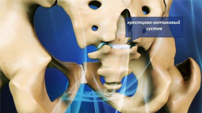 Лікування артрозу куприка народними засобами –