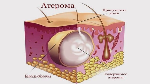 Лікування атероми в домашніх умовах: видалення за вухом іхтіолової маззю та іншими народними засобами