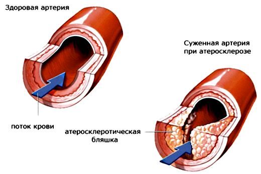Лікування атеросклерозу народними засобами найефективніші