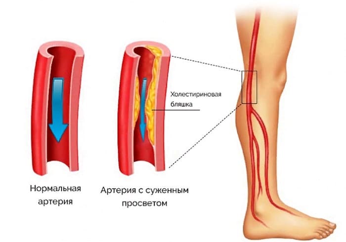 Лікування атеросклерозу нижніх кінцівок народними засобами