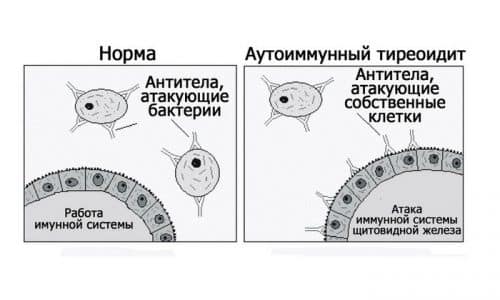 Лікування аутоімунного тиреоїдиту АІТ народними засобами