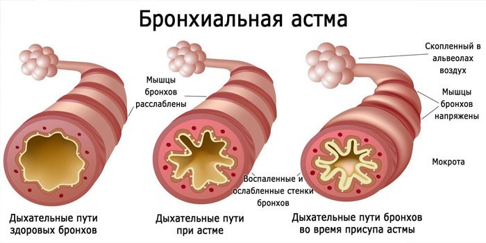 Лікування бронхіальної астми народними засобами в домашніх умовах