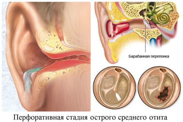 Лікування ексудативного отиту у дитини