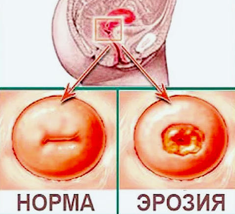 Лікування ерозії шийки матки народними способами