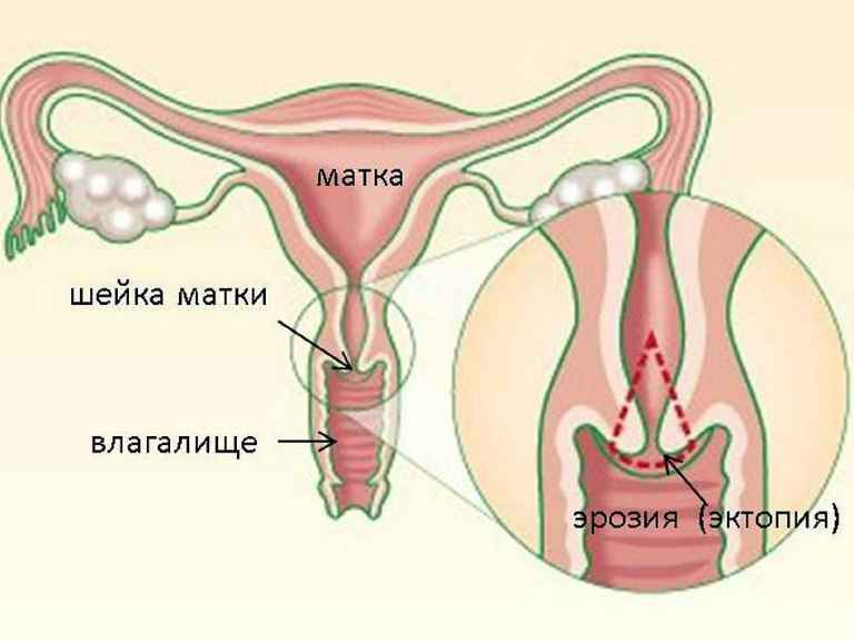 Лікування ерозії шийки матки народними способами