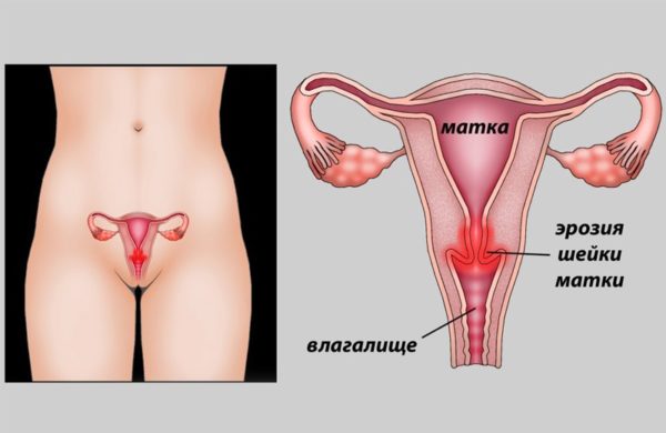 Лікування ерозії шийки матки за допомогою свічок список препаратів