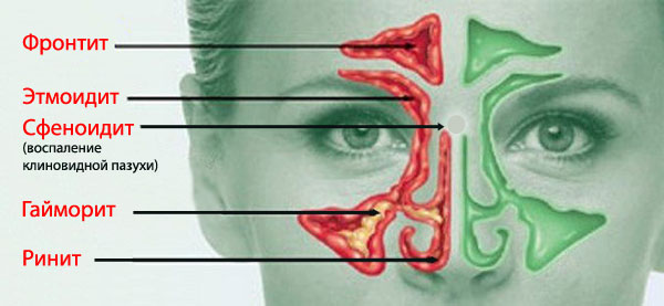 Лікування етмоїдиту препаратами і народними засобами. Етмоїдит у дорослих, симптоми, лікування та профілактика