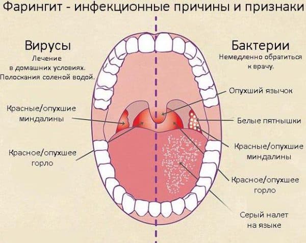 Лікування фарингіту при вагітності та його вплив на плід. Особливості лікування фарингіту при вагітності