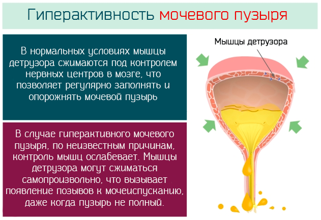 Лікування гіперактивного сечового міхура
