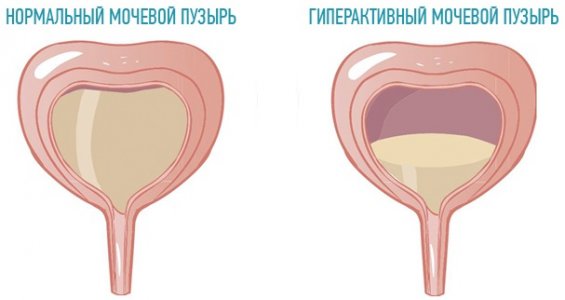 Лікування гіперактивного сечового міхура