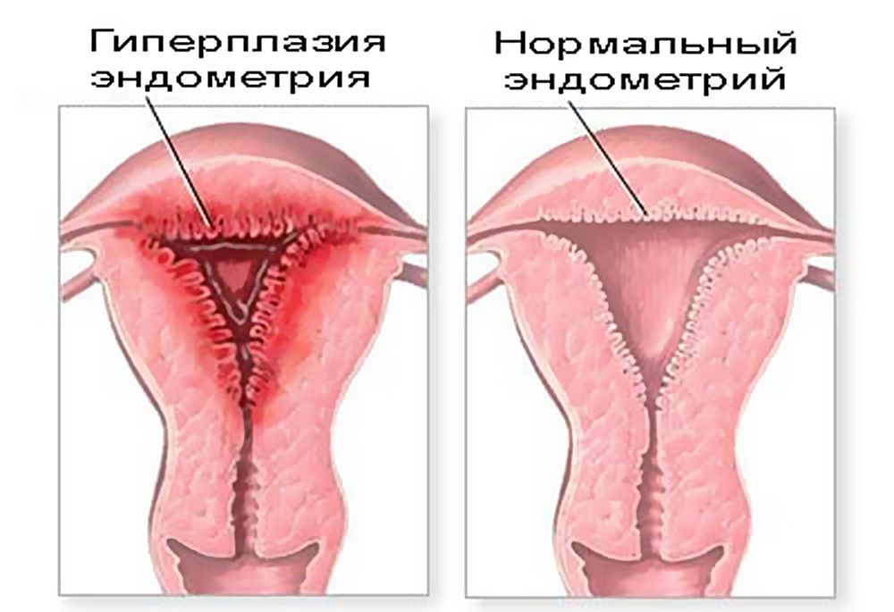 Лікування гіперплазії ендометрія після вискоблювання
