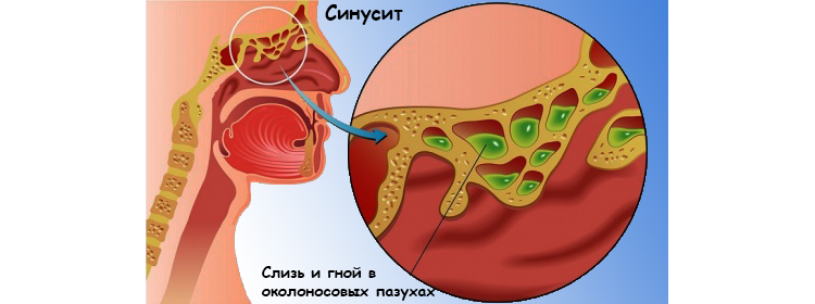 Лікування гаймориту без проколів в домашніх умовах