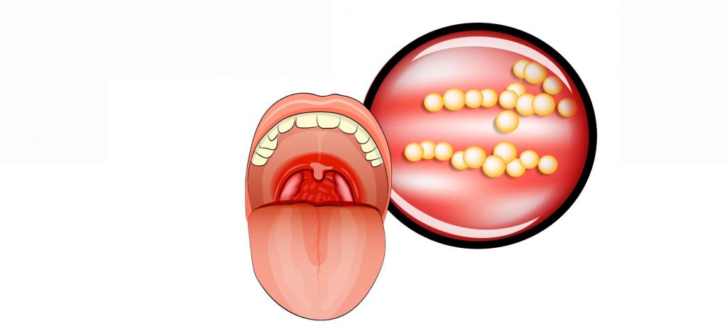 Лікування гаймориту гомеопатією. Огляд гомеопатичних препаратів