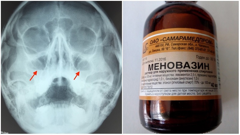 Лікування гаймориту Меновазином способи застосування ліків