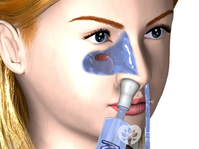 Лікування гаймориту методом «Зозуля»