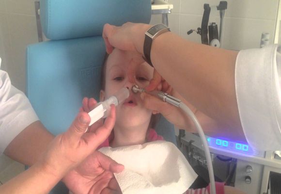 Лікування гаймориту методом «Зозуля»